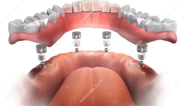 <!--<i data=20240703-sp></i>-->亿大口腔种植牙技术