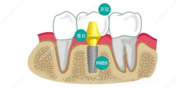 <!--<i data=20240703-sp></i>-->亿大口腔种植牙价格