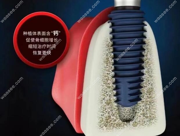 美格真蓝色种植体优势