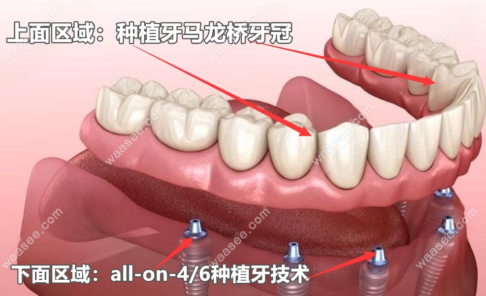 马龙桥和all on 4有什么区别