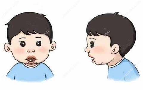 均角面型（正常型）也可以用牙齿矫正来改善下巴后缩