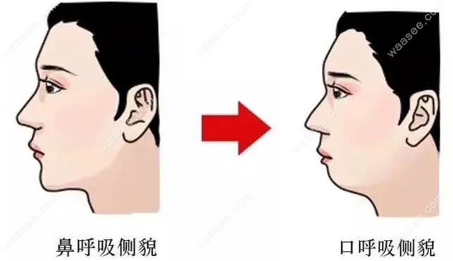 牙齿矫正可以利用3点来改善下巴后缩