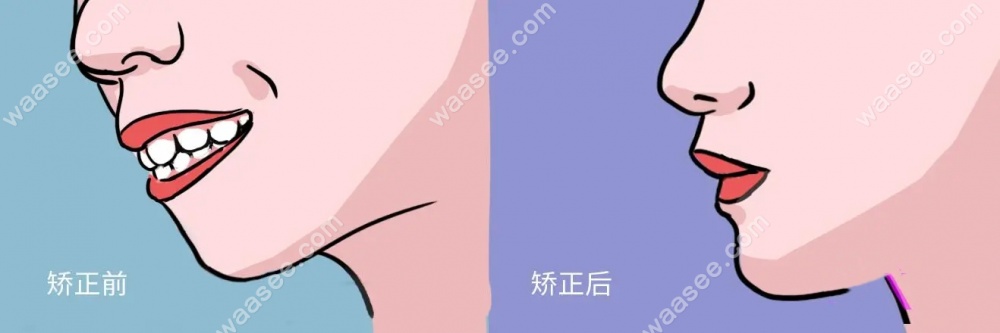 揭秘：牙齿矫正如何改善下巴后缩。waasee.com
