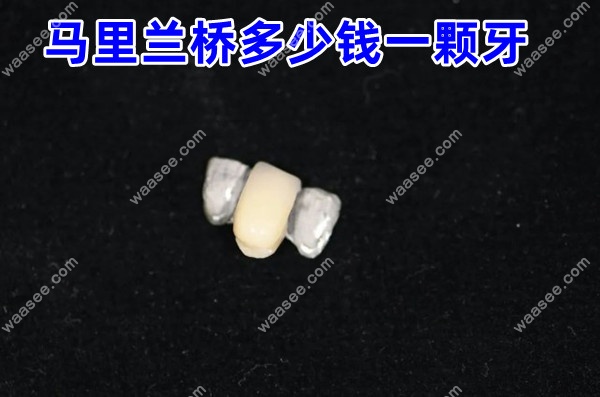 马里兰桥多少钱一颗牙