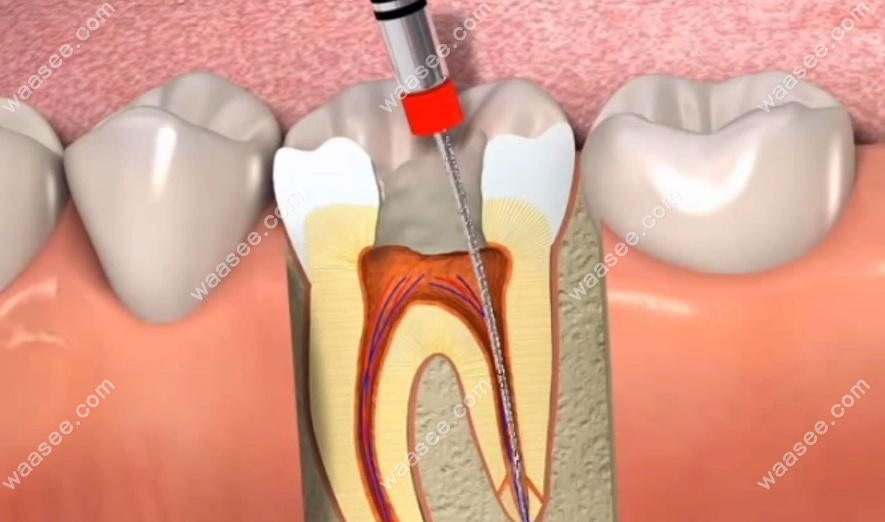 急性牙髓炎做一次根管还是多次根管好?据临床看有效的是...