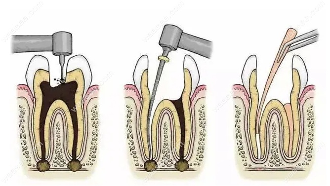 牙髓摘除术是不是杀牙神经?不是，那和根管治疗有什么区别