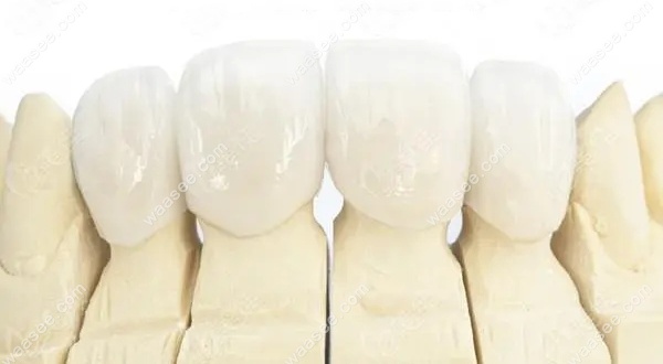 瑞典procera全瓷牙能用多少年waasee.com