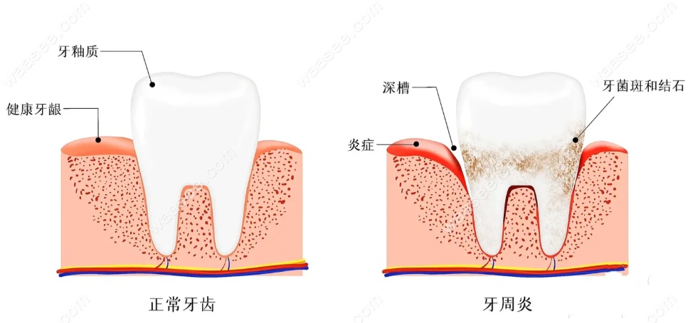 全口牙周刮治痛吗