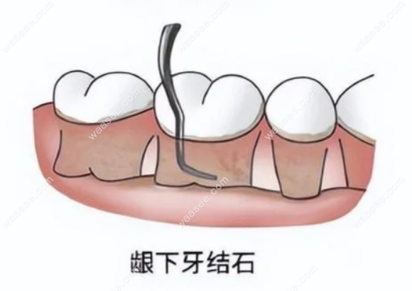 全口牙周刮治痛吗www.waasee.com