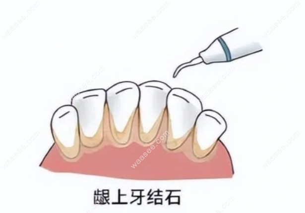 全口牙周刮治多少钱一次