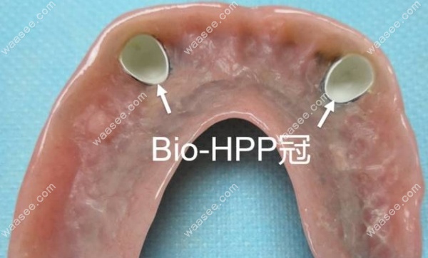 hpp假牙支架是什么材料