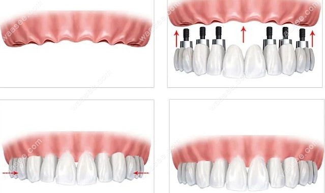 重度牙周炎牙齿掉光后种植牙