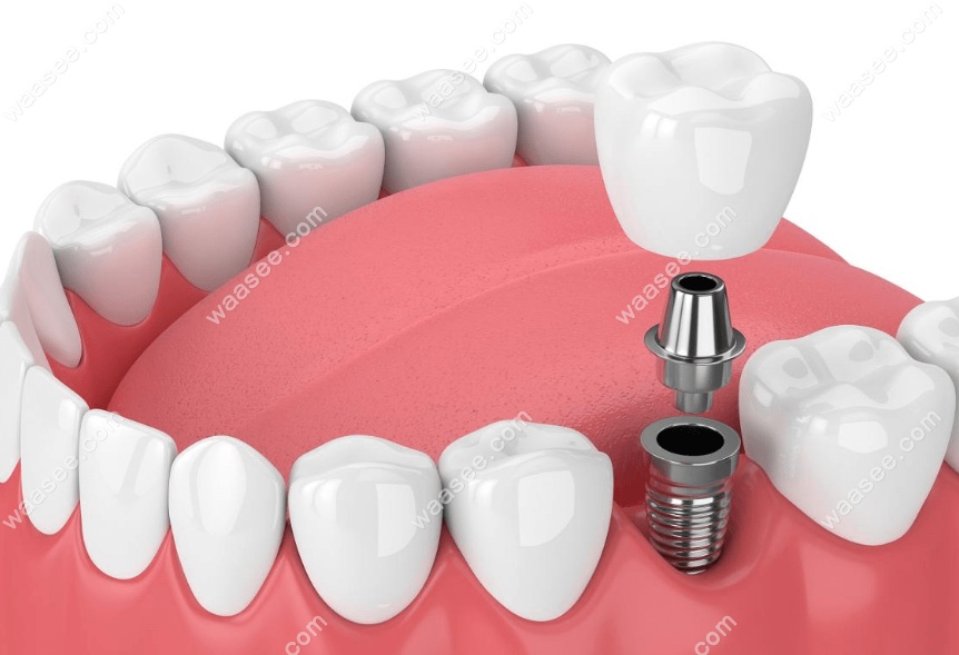 海德堡口腔医院种植牙检查是免费的吗