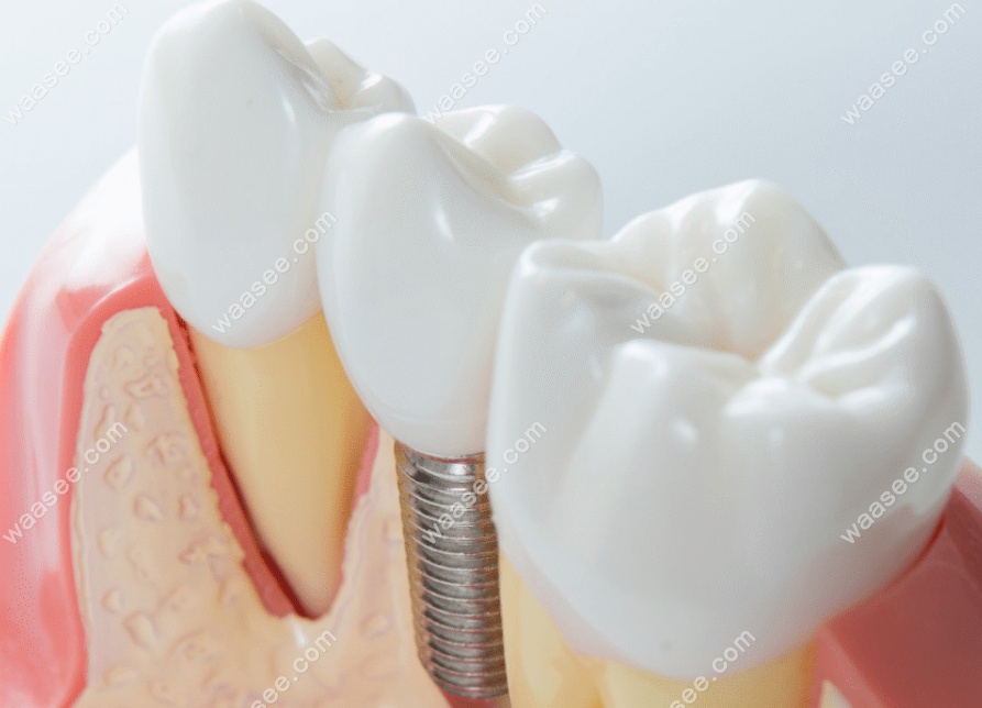 种植牙后临时牙装还是不装好？门牙种植过渡期需要戴假牙