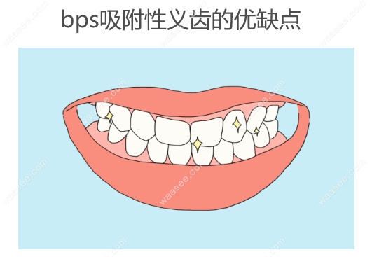 bps吸附性义齿的优缺点