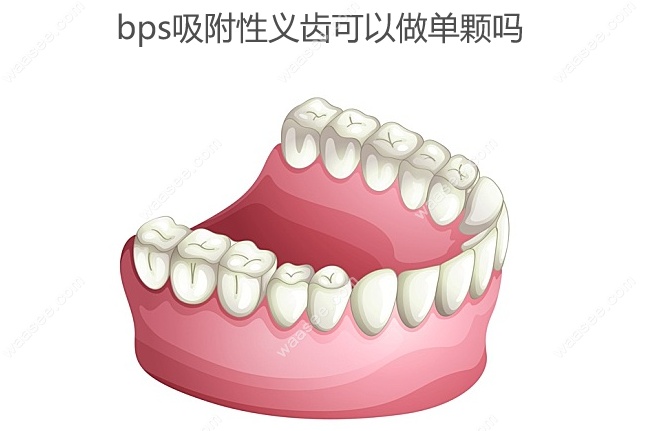 bps吸附性义齿可以做单颗吗
