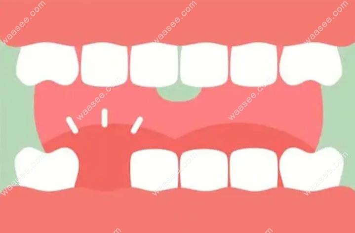 隐形义齿戴多久会导致牙槽骨吸收
