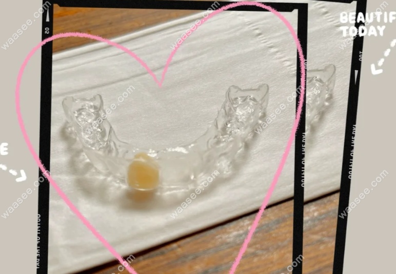 门牙缺失好的修复方法www.waasee.com