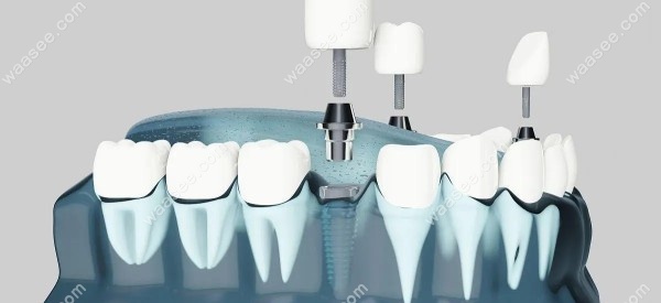 种植牙连体牙冠和独立牙冠哪个好waasee.com