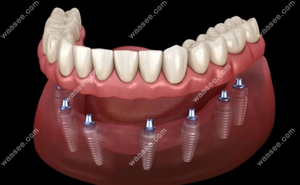种植牙单颗牙冠和连体牙冠的区别