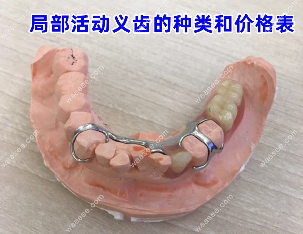 局部活动义齿的种类和价格表