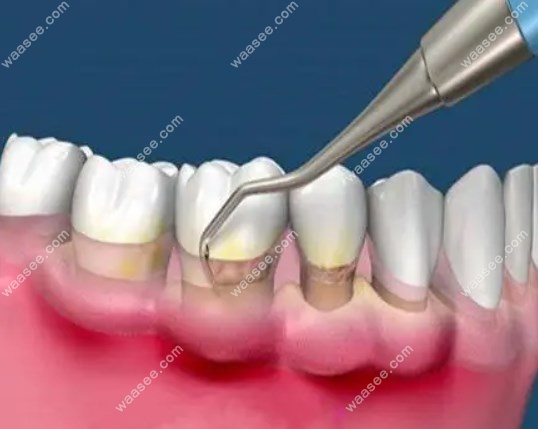 龈下刮治能治好牙周炎吗?龈下刮治会疼但不能治好牙周炎