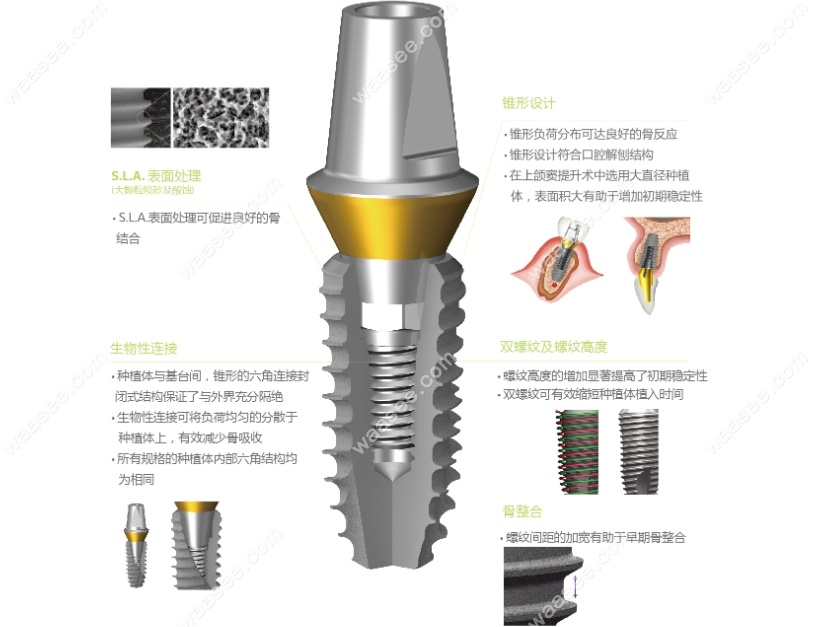 登腾种植体不同系列的特色