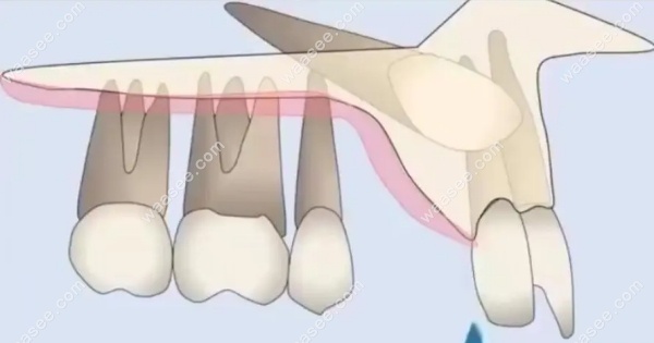 埋伏牙是怎么形成的
