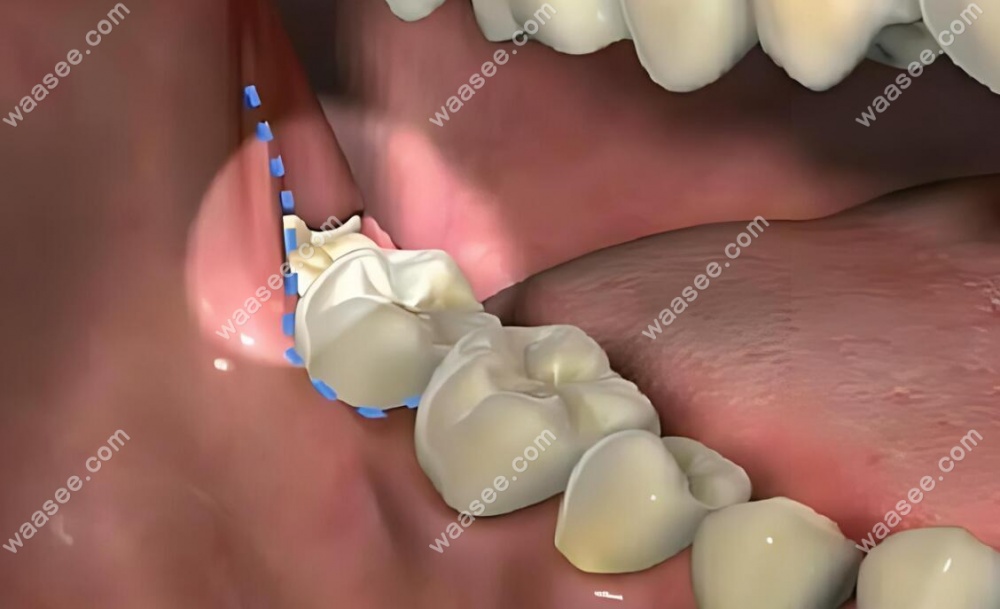 有人做过牙龈修复手术吗?亲身经历牙龈修补手术后谈其利弊