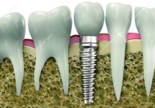 人工种植牙齿有哪些后遗症www.hryjz.com