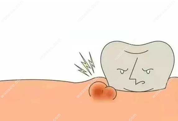 牙根尖囊肿拔牙后影响愈合吗