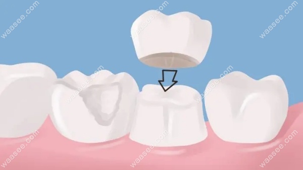 种植牙牙冠更换复杂吗