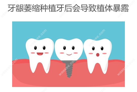 牙龈萎缩种植牙后会导致植体暴露