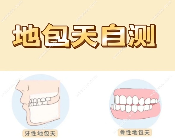 功能性反颌诊断标准