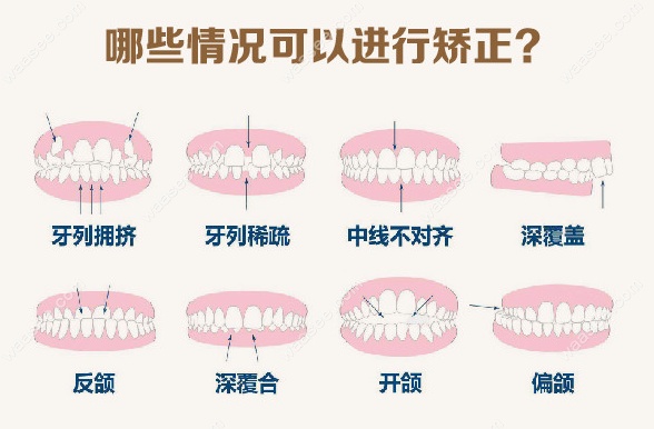 舌侧正畸认证的医生有哪些www.waasee.com