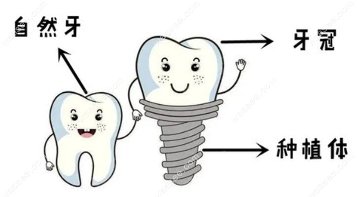 不同假牙类型收费不同