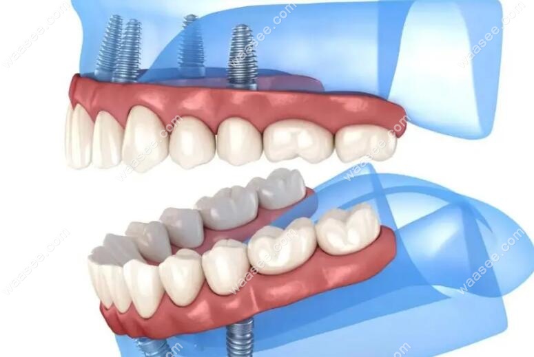 德国SKY种植牙是四级纯钛材质