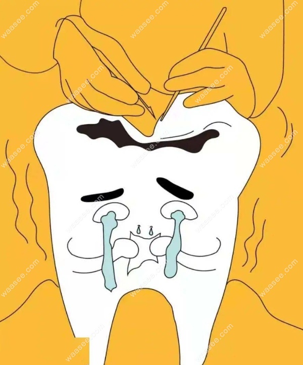 根管治疗后的牙齿还会发生继发龋吗