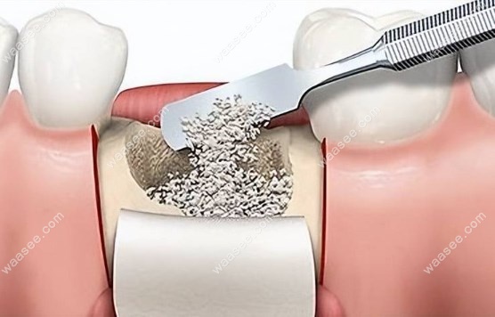 种牙骨粉需要多久可以变成骨头?揭秘时间进程与影响因素