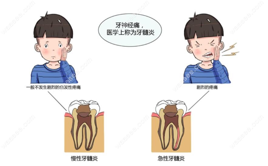 牙髓炎疼痛加剧waasee.com