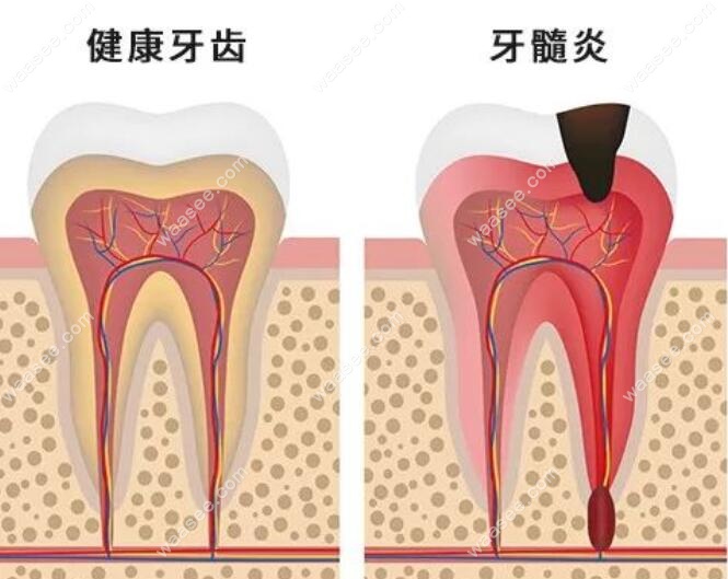 健康牙齿和牙髓炎的区别之处