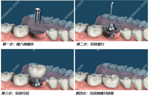贵阳柏乐口腔和柏德口腔种牙好