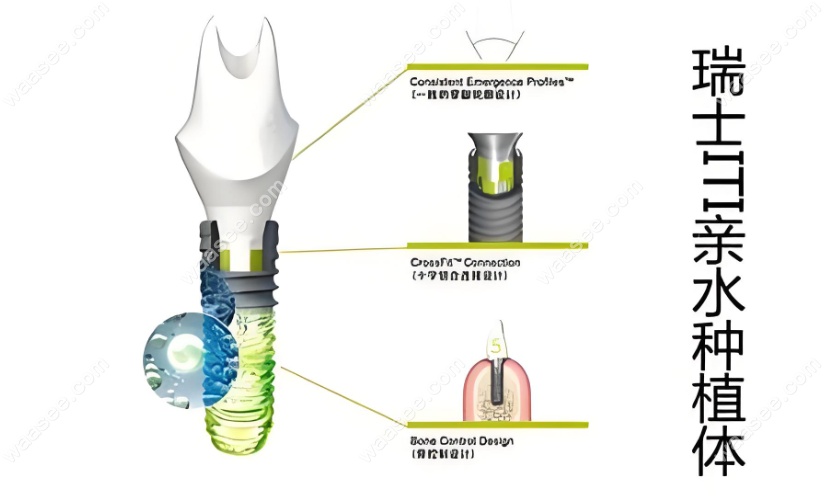 瑞士iti悦皓与瑞锆种植牙