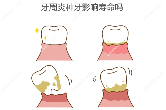 牙周炎种牙影响寿命吗,牙周炎期间种植牙成功几率不高