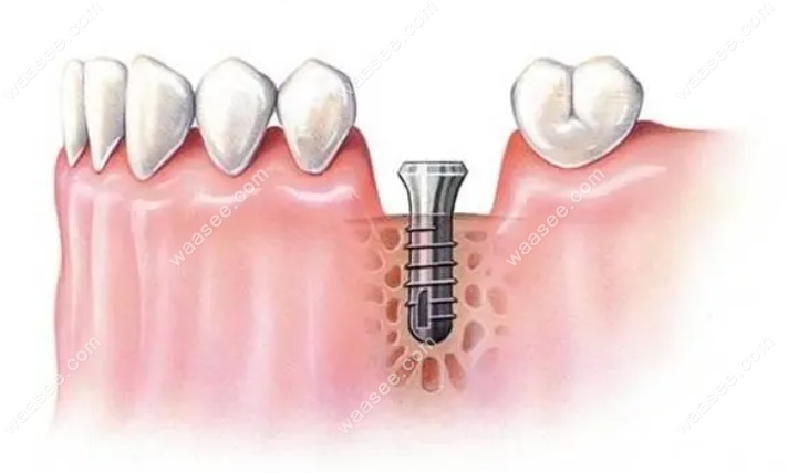 牙槽骨吸收至根尖1/3还能种牙
