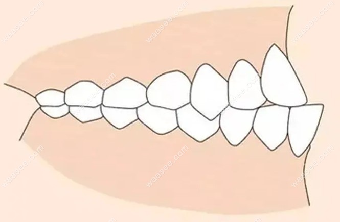 骨性凸嘴可以靠整牙改善吗
