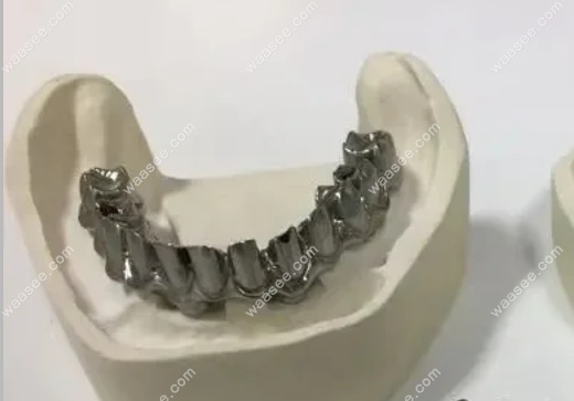 马泷桥种植牙技术应用于半/全口重建,优势亮点深度解读