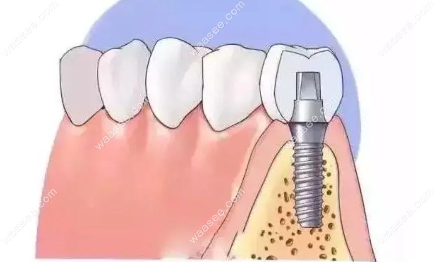 重度牙周炎患者种植牙修复
