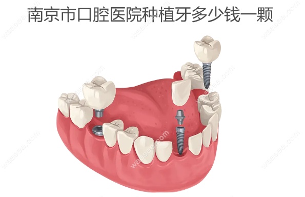 南京市口腔医院种植牙多少钱一颗