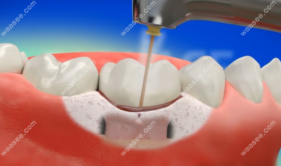 牙周炎导致牙龈萎缩